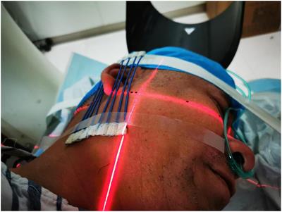 CT-guided radiofrequency ablation of the extracranial cranial nerve for the treatment of Meige’s syndrome